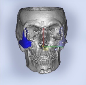 CBCT-scan voor PEEK-implantaten - o2 Clinic CBCT-scan voor PEEK