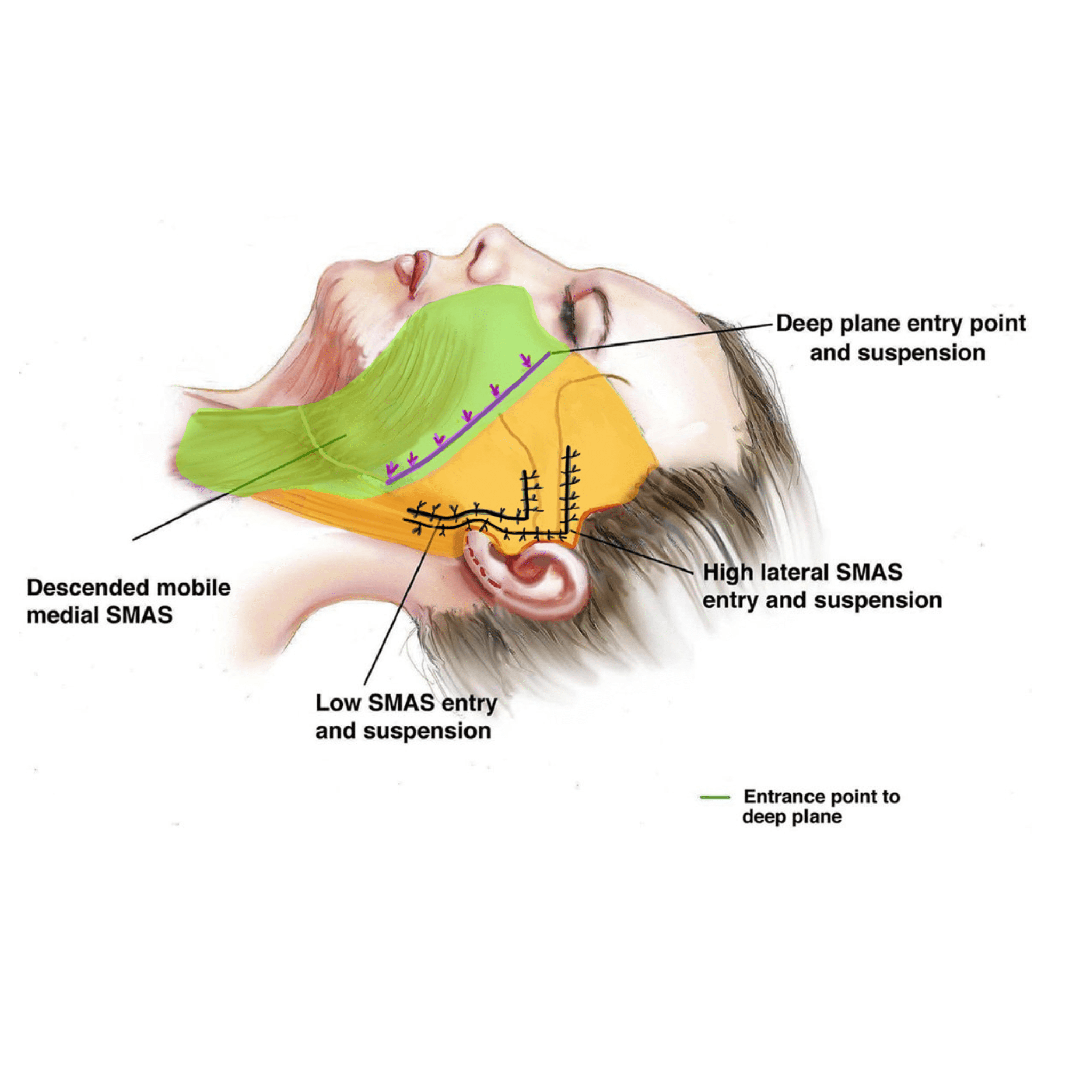 Deep Plane Facelift - o2 Clinic Deep Plane Facelift - o2 Clinic
