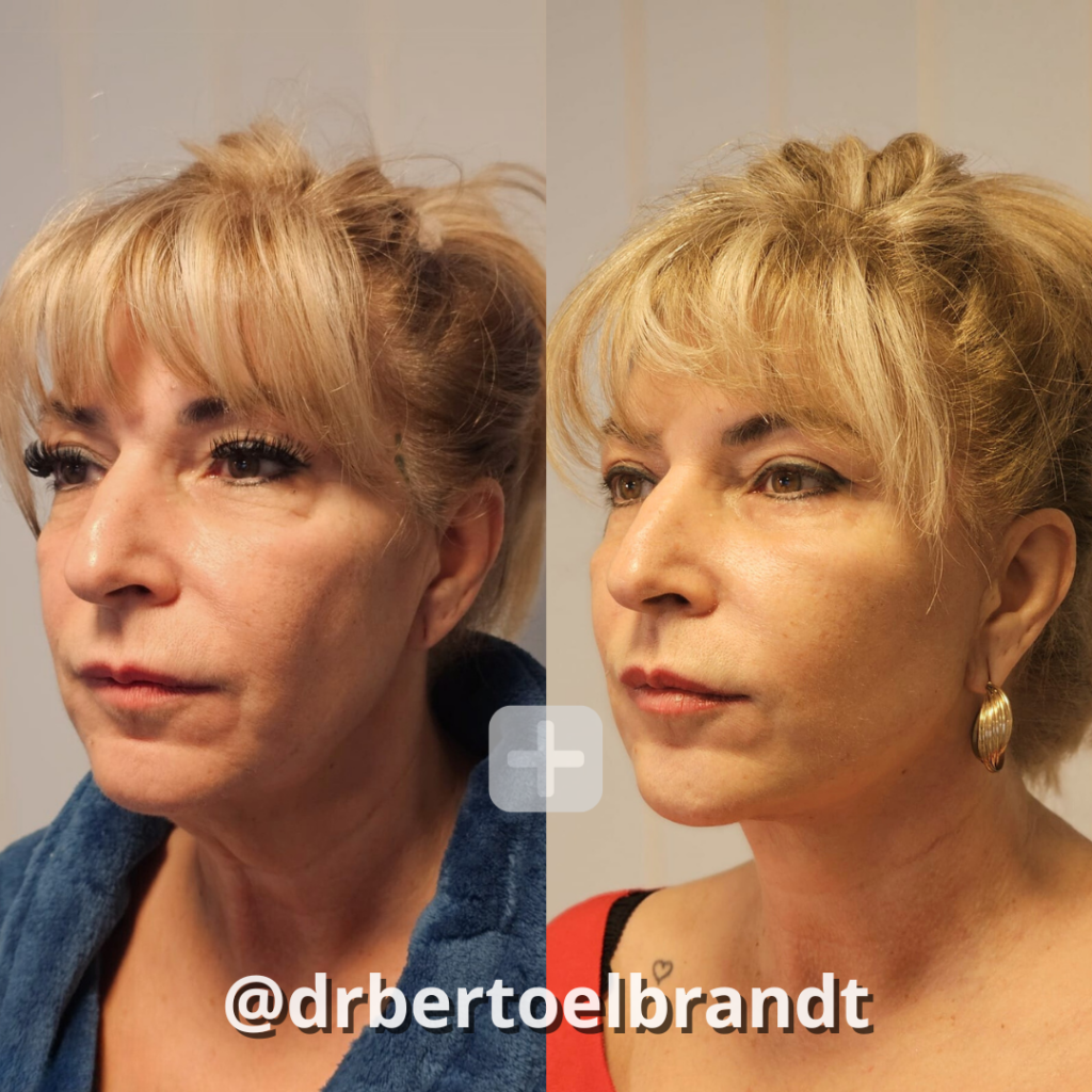 Deep Plane Facelift - o2 Clinic Deep Plane Facelift - o2 Clinic