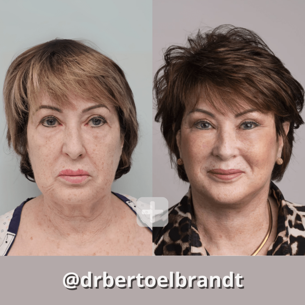 Deep Plane Facelift - o2 Clinic Deep Plane Facelift - o2 Clinic