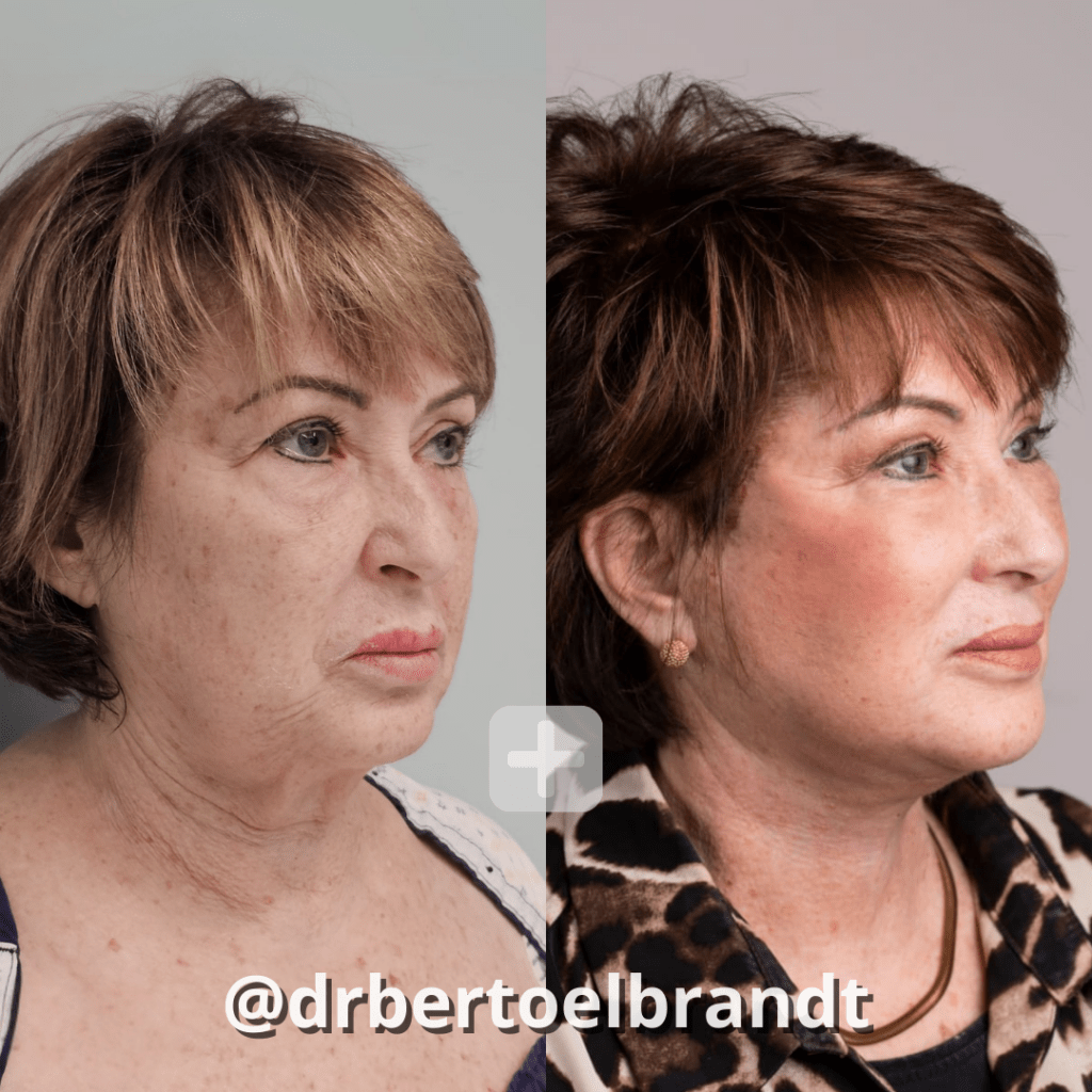 Deep Plane Facelift - o2 Clinic Deep Plane Facelift - o2 Clinic