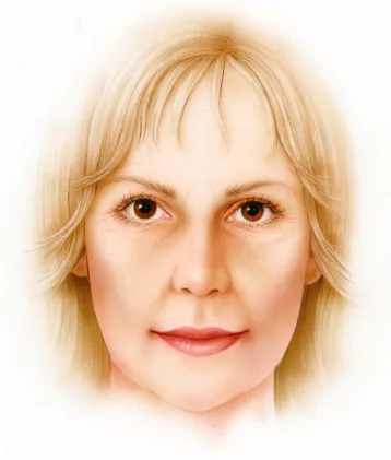 Deep Plane Facelift - o2 Clinic Deep Plane Facelift - o2 Clinic