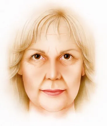 Deep Plane Facelift - o2 Clinic Deep Plane Facelift - o2 Clinic