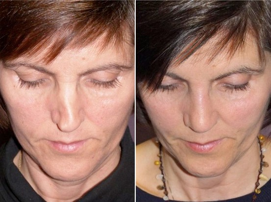 Neuscorrectie, verbeter de vorm en balans van je neus - o2 Clinic neuscorrectie