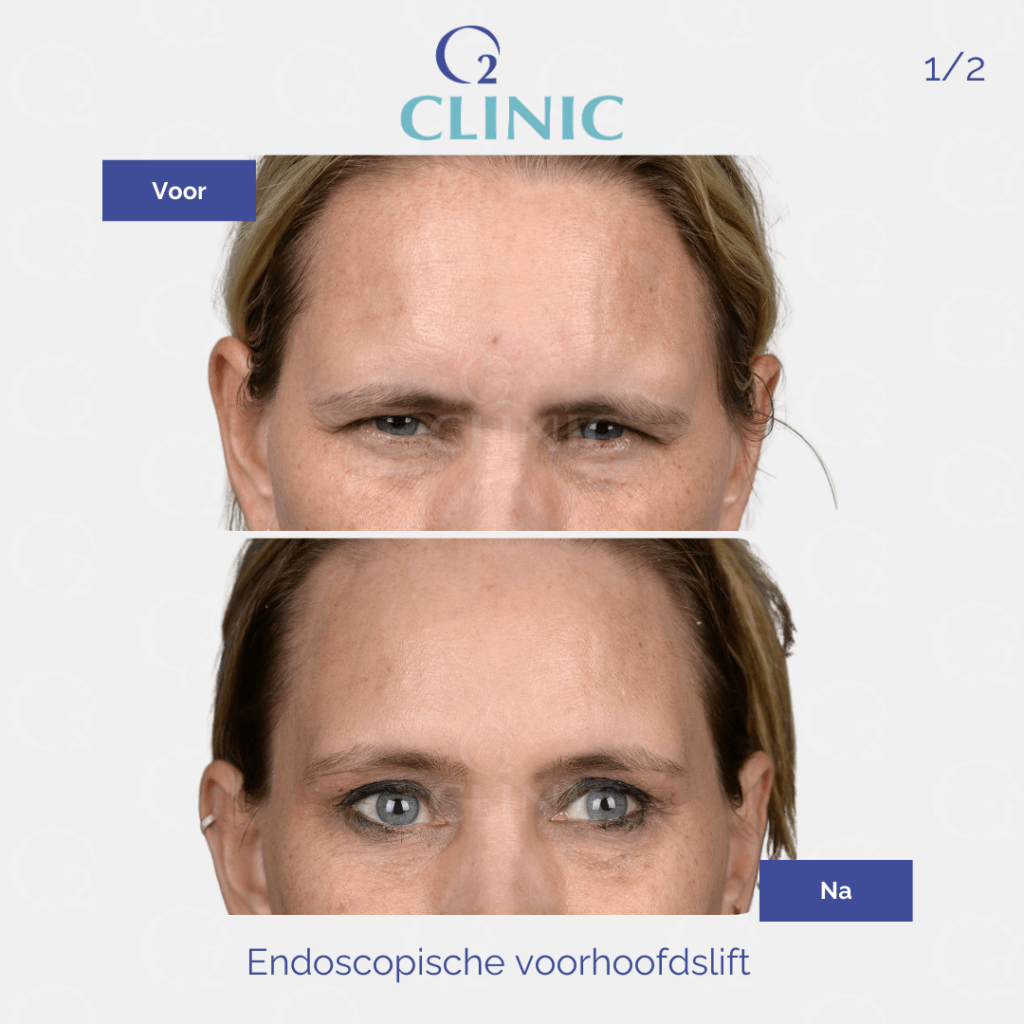 Endoscopische voorhoofdslift - o2 Clinic endoscopische voorhoofdslift