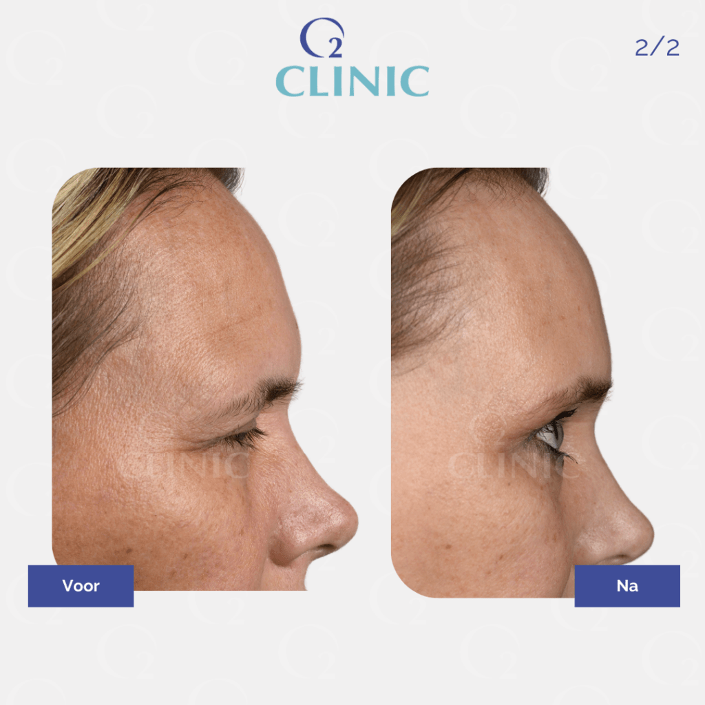 Endoscopische voorhoofdslift - o2 Clinic endoscopische voorhoofdslift