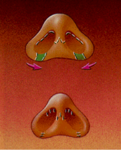 Neuscorrectie, verbeter de vorm en balans van je neus - o2 Clinic neuscorrectie