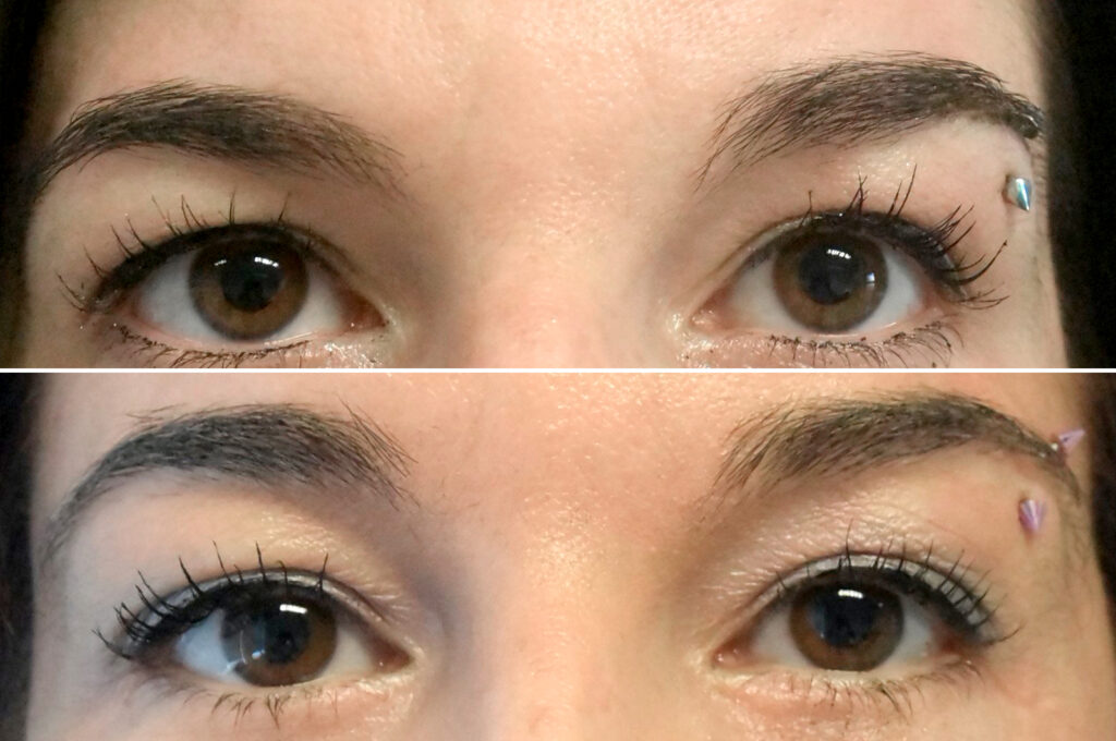 Endoscopische voorhoofdslift - o2 Clinic Endoscopische voorhoofdslift - o2 Clinic