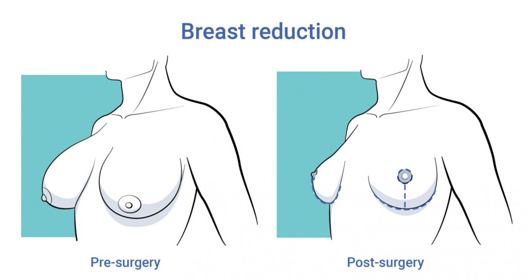 Borstverkleining - o2 Clinic