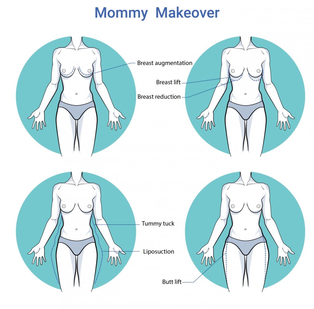Mommy makeover