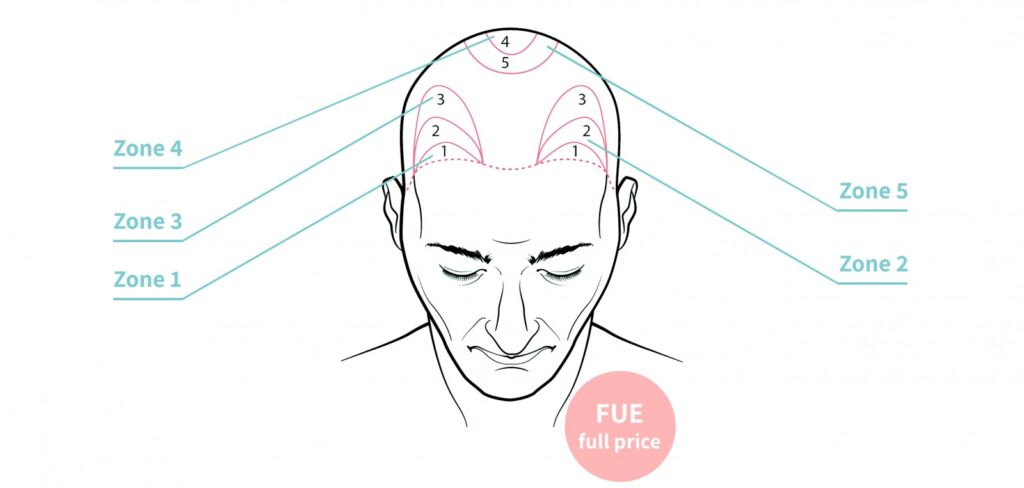 Haartransplantatie - FUE - o2 Clinic Haartransplantatie - FUE - o2 Clinic