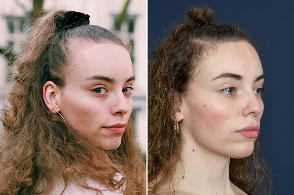 Haartransplantatie - FUE - o2 Clinic Haartransplantatie - FUE - o2 Clinic